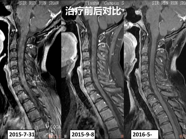 【病例】视神经脊髓炎1例MR影像表现