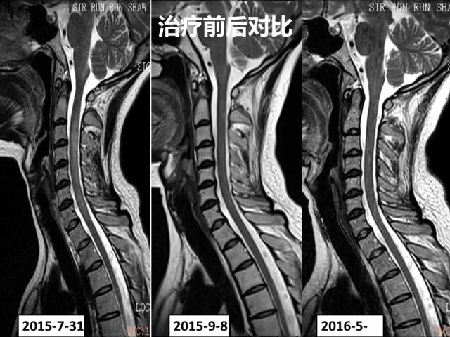 【病例】视神经脊髓炎1例MR影像表现