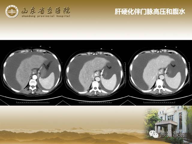 【PPT】肝脏影像学培训内容