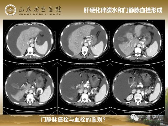 【PPT】肝脏影像学培训内容