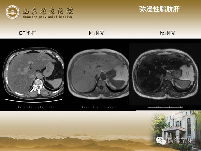 【PPT】肝脏影像学培训内容