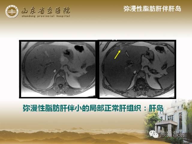 【PPT】肝脏影像学培训内容