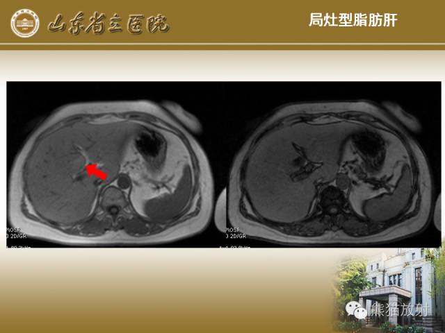 【PPT】肝脏影像学培训内容