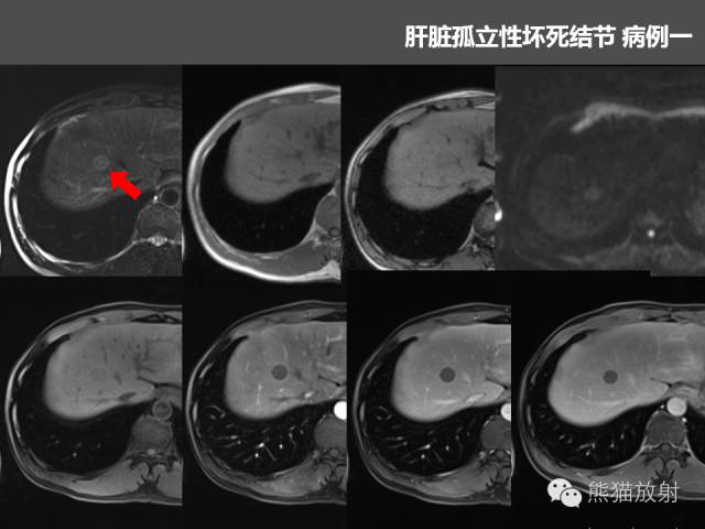 【PPT】肝脏影像学培训内容