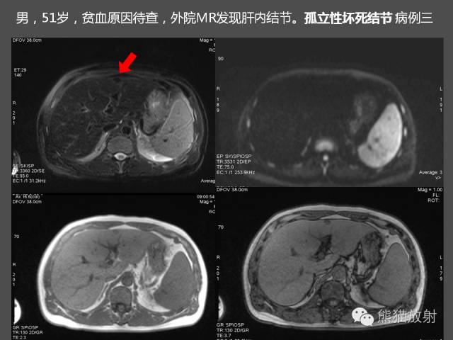 【PPT】肝脏影像学培训内容