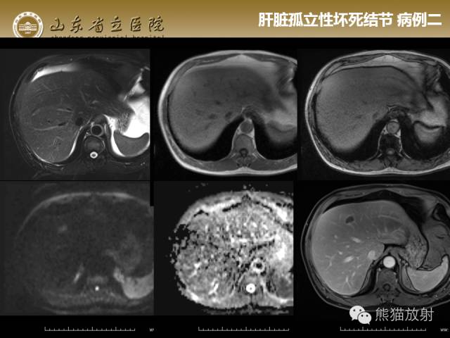 【PPT】肝脏影像学培训内容