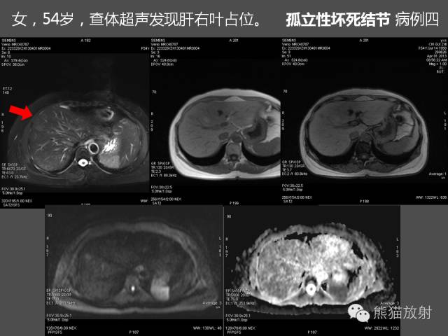 【PPT】肝脏影像学培训内容