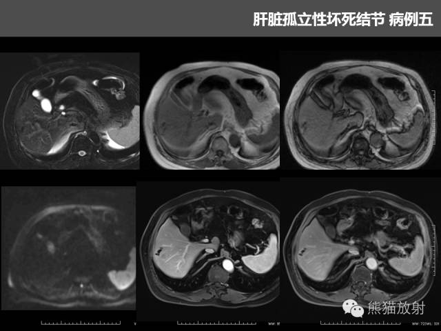 【PPT】肝脏影像学培训内容