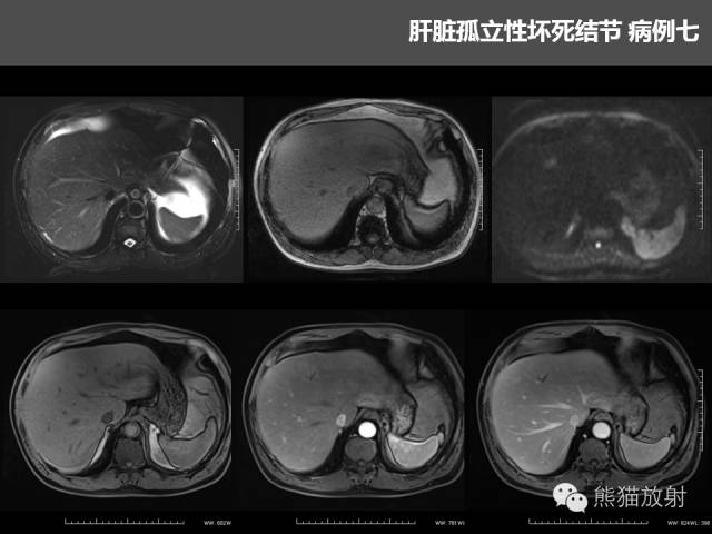 【PPT】肝脏影像学培训内容