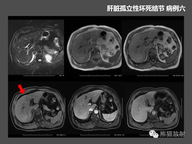 【PPT】肝脏影像学培训内容