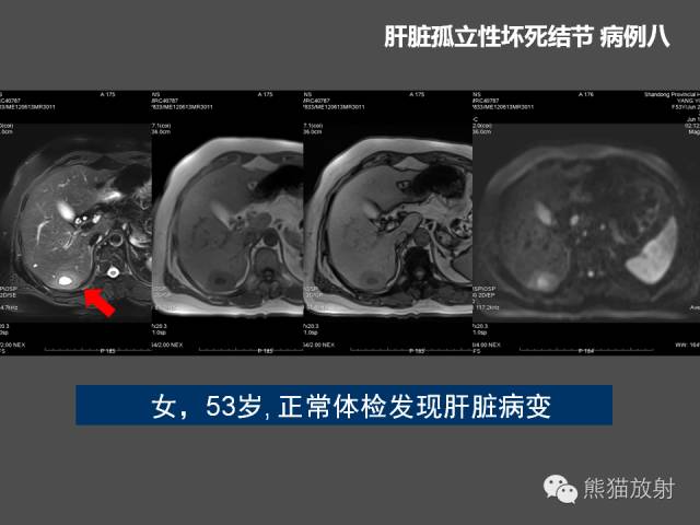 【PPT】肝脏影像学培训内容