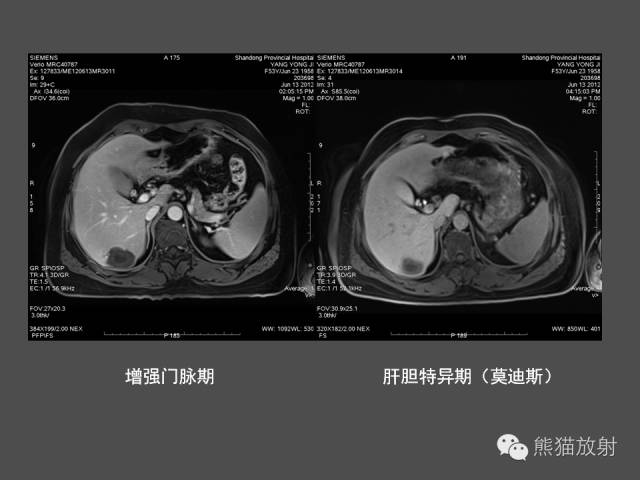 【PPT】肝脏影像学培训内容