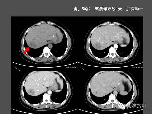 【PPT】肝脏影像学培训内容