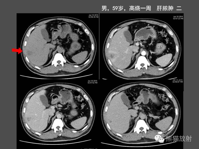 【PPT】肝脏影像学培训内容