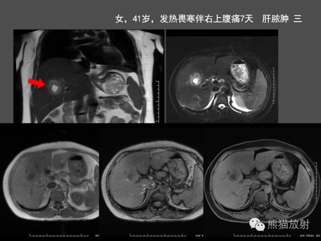 【PPT】肝脏影像学培训内容