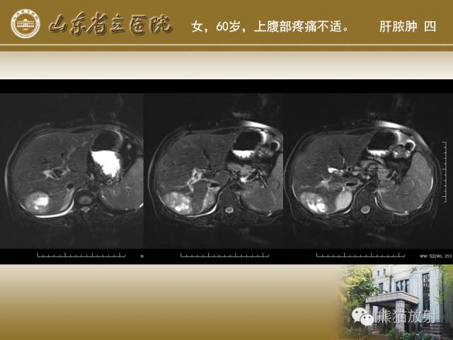 【PPT】肝脏影像学培训内容
