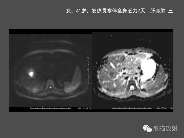 【PPT】肝脏影像学培训内容