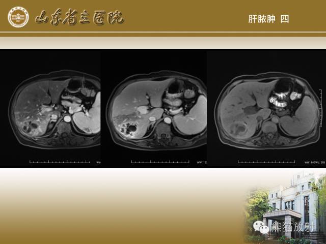 【PPT】肝脏影像学培训内容