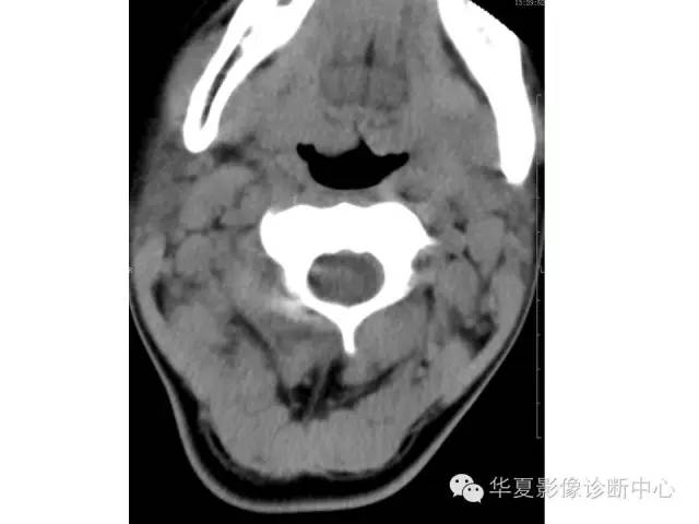 【病例】颈部巨淋巴结增生一例