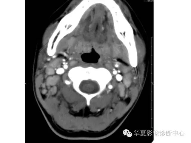 【病例】颈部巨淋巴结增生一例