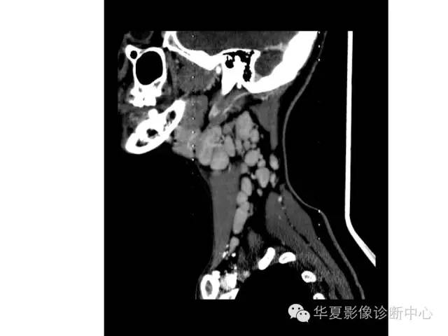 【病例】颈部巨淋巴结增生一例