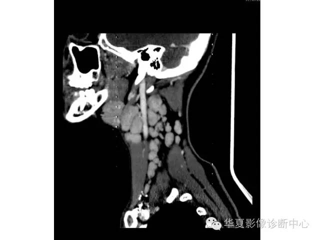 【病例】颈部巨淋巴结增生一例