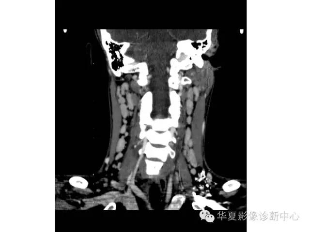 【病例】颈部巨淋巴结增生一例