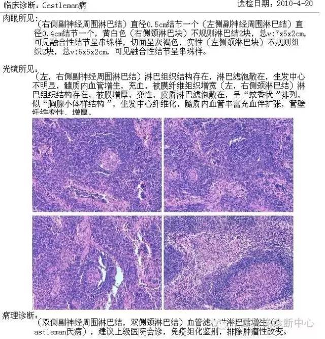 【病例】颈部巨淋巴结增生一例