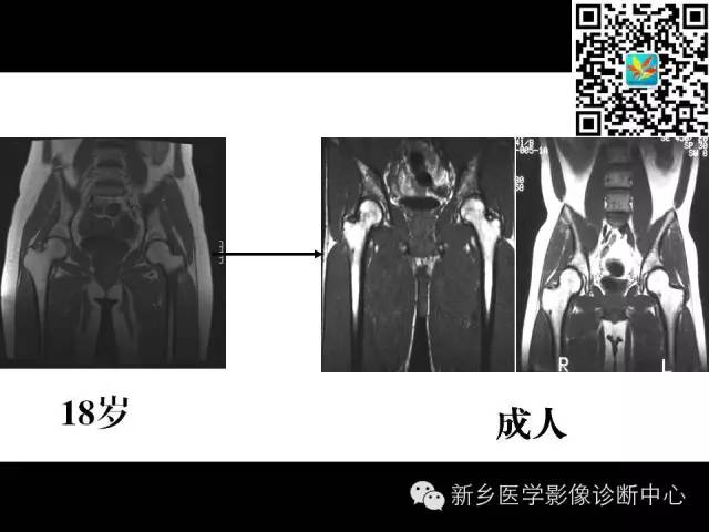【PPT】髋部骨髓水肿综合征