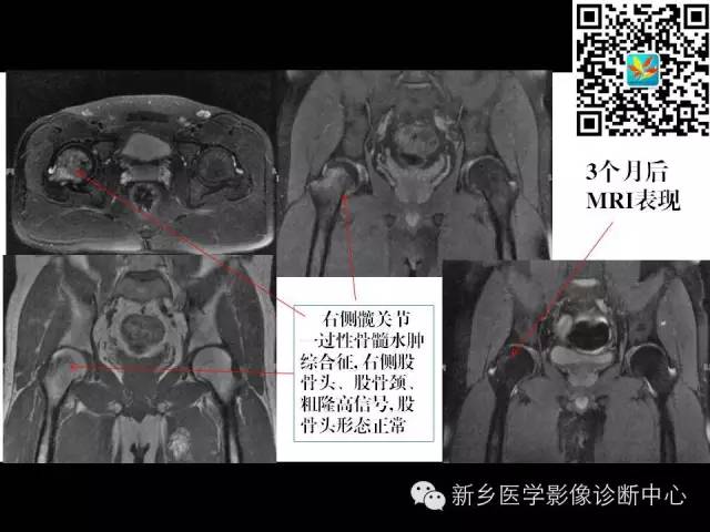 【PPT】髋部骨髓水肿综合征