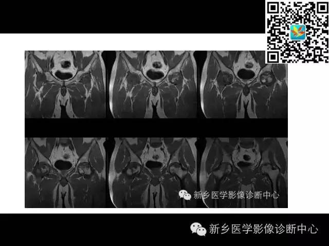 【PPT】髋部骨髓水肿综合征