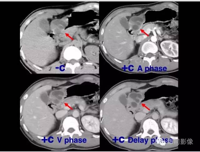 【病例】胃窦异位胰腺1例CT影像表现