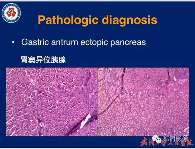 【病例】胃窦异位胰腺1例CT影像表现