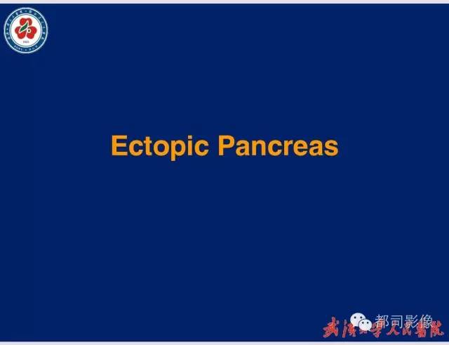 【病例】胃窦异位胰腺1例CT影像表现