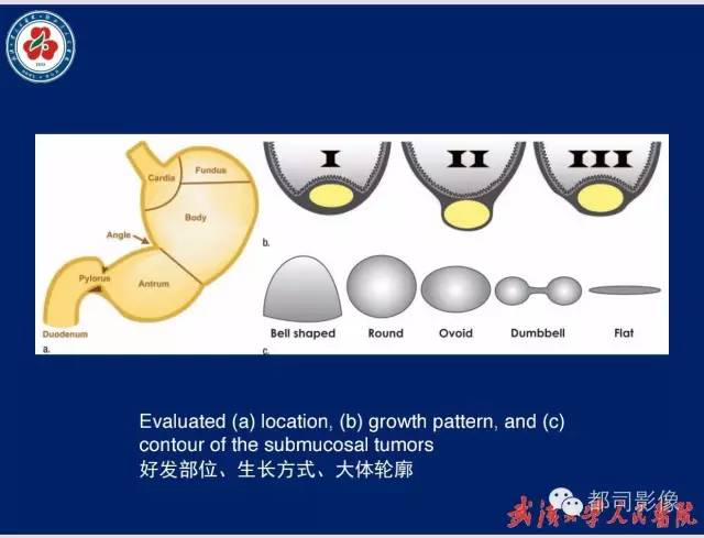 【病例】胃窦异位胰腺1例CT影像表现