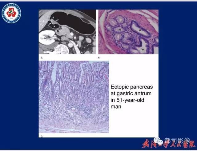 【病例】胃窦异位胰腺1例CT影像表现