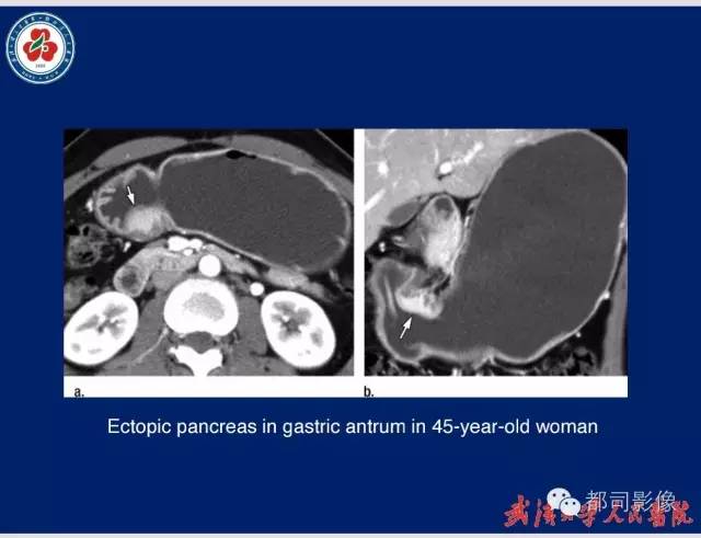 【病例】胃窦异位胰腺1例CT影像表现