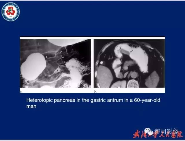 【病例】胃窦异位胰腺1例CT影像表现