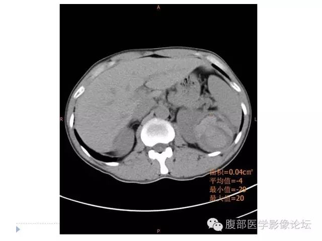 【病例】左肾血管平滑肌脂肪瘤1例CT影像表现 【病例】左肾血管平滑肌脂肪瘤1例CT影像表现