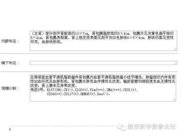 【病例】左肾血管平滑肌脂肪瘤1例CT影像表现 【病例】左肾血管平滑肌脂肪瘤1例CT影像表现