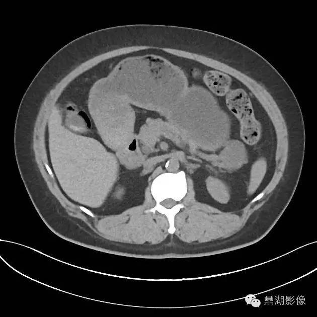 【病例】胰腺浆液性囊腺瘤1例CT影像表现 【病例】胰腺浆液性囊腺瘤1例CT影像表现