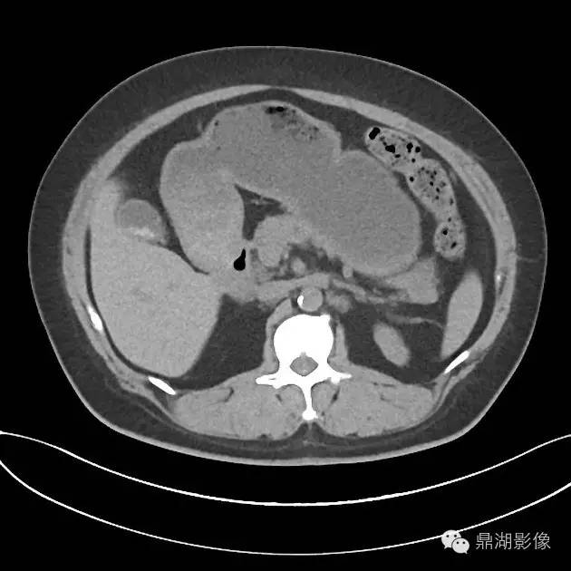 【病例】胰腺浆液性囊腺瘤1例CT影像表现 【病例】胰腺浆液性囊腺瘤1例CT影像表现