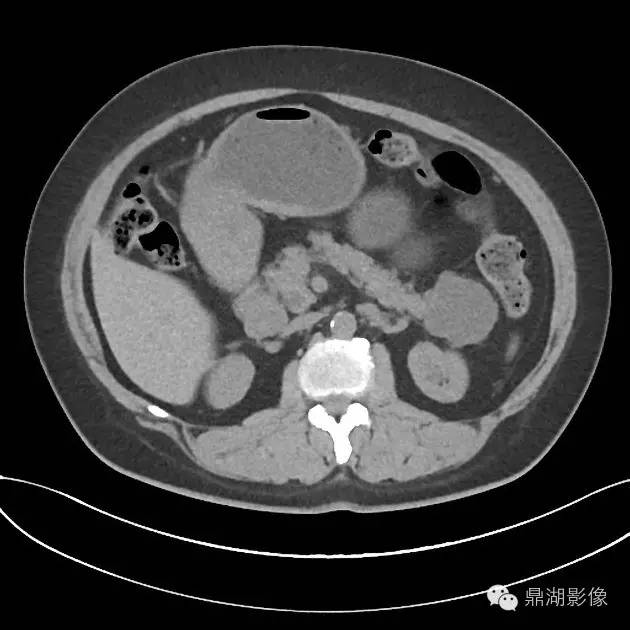 【病例】胰腺浆液性囊腺瘤1例CT影像表现 【病例】胰腺浆液性囊腺瘤1例CT影像表现