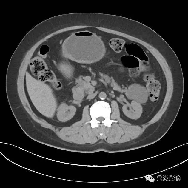 【病例】胰腺浆液性囊腺瘤1例CT影像表现 【病例】胰腺浆液性囊腺瘤1例CT影像表现