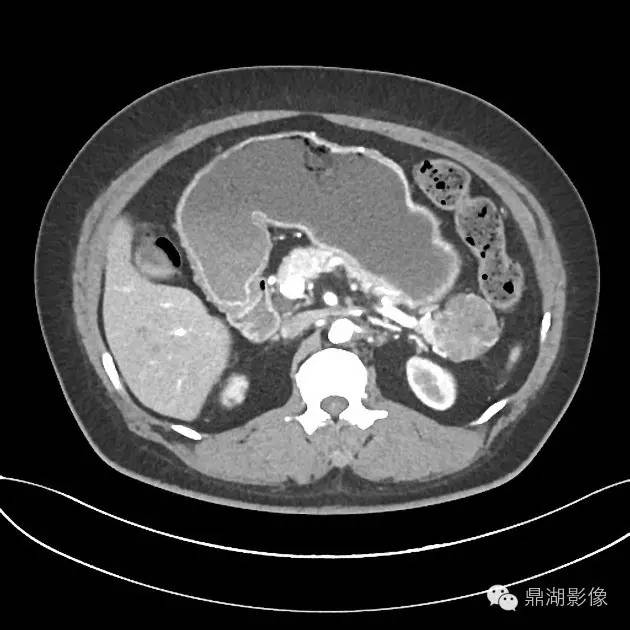 【病例】胰腺浆液性囊腺瘤1例CT影像表现 【病例】胰腺浆液性囊腺瘤1例CT影像表现