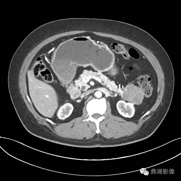 【病例】胰腺浆液性囊腺瘤1例CT影像表现 【病例】胰腺浆液性囊腺瘤1例CT影像表现