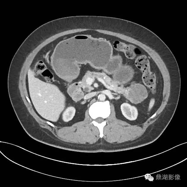 【病例】胰腺浆液性囊腺瘤1例CT影像表现 【病例】胰腺浆液性囊腺瘤1例CT影像表现
