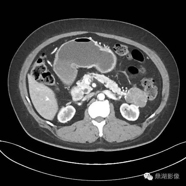 【病例】胰腺浆液性囊腺瘤1例CT影像表现 【病例】胰腺浆液性囊腺瘤1例CT影像表现