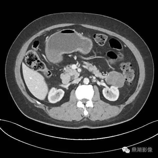 【病例】胰腺浆液性囊腺瘤1例CT影像表现 【病例】胰腺浆液性囊腺瘤1例CT影像表现