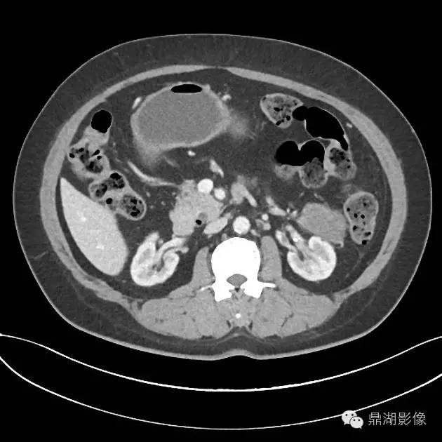 【病例】胰腺浆液性囊腺瘤1例CT影像表现 【病例】胰腺浆液性囊腺瘤1例CT影像表现